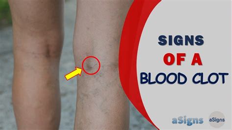 Blood clots can . . Pictures of blood clot behind knee